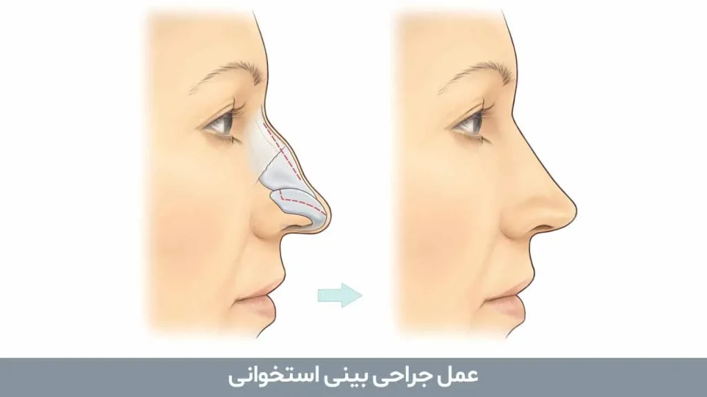 بینی استخوانی بینی استخوانی