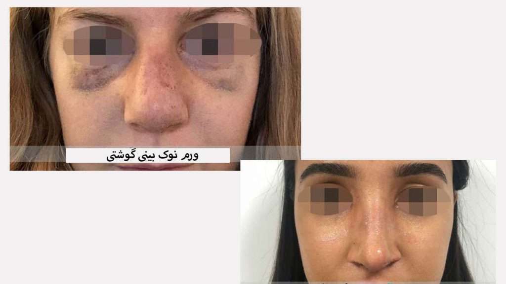 ورم نوک بینی گوشتی بعد عمل ورم نوک بینی گوشتی