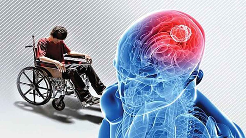 نشانه بیماری ام اس بیماری ام اس در بزرگسالان چه علائمی دارد
