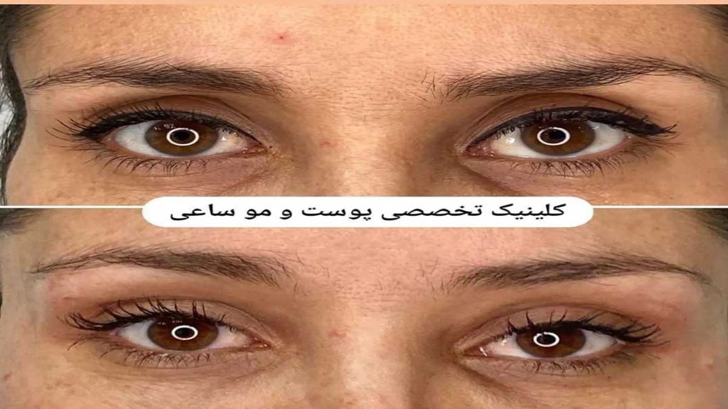 جراحی پلک بالا عمل بلفاروپلاستی پلک بالا