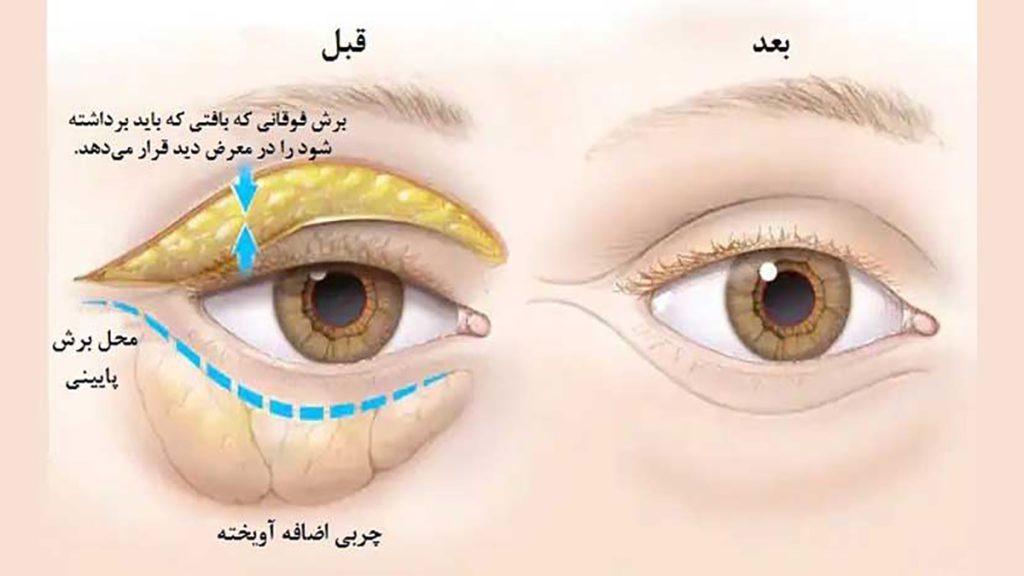 عمل پلک بدون برش و بخیه عمل بلفاروپلاستی بدون جراحی