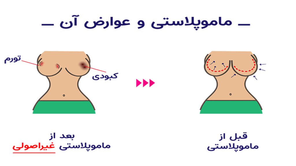 عوارض ماموپلاستی عوارض ماموپلاستی کدامند
