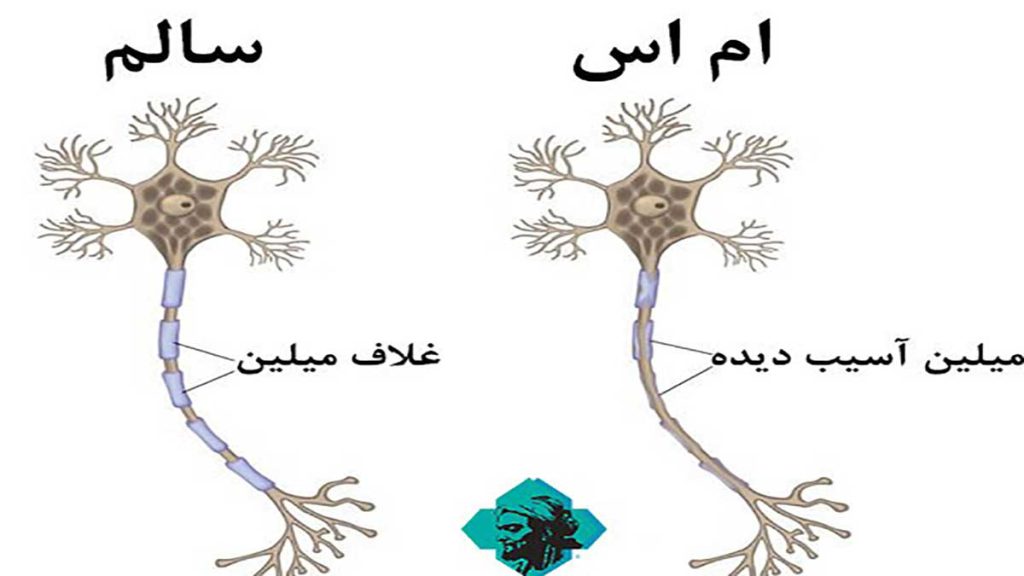 4 نوع بیماری ام اس معرفی انواع بیماری ام اس