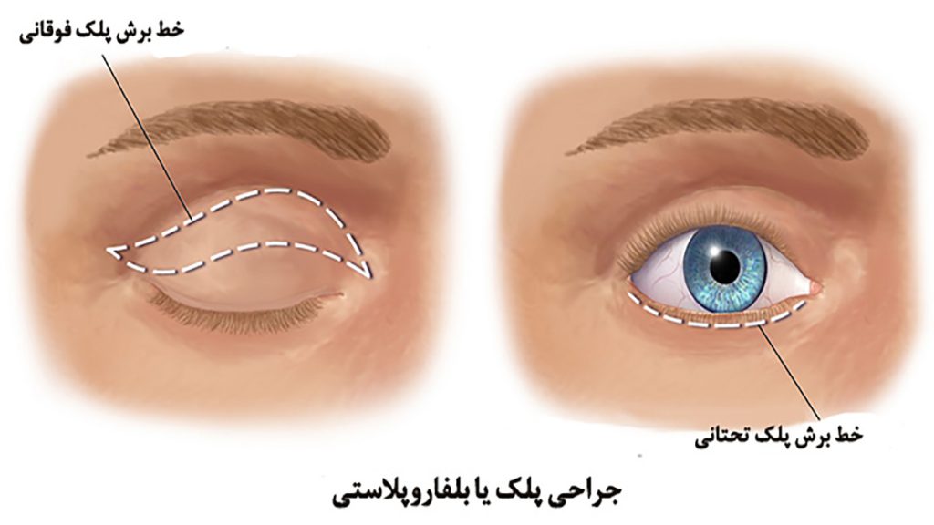 عمل بلفاروپلاستی