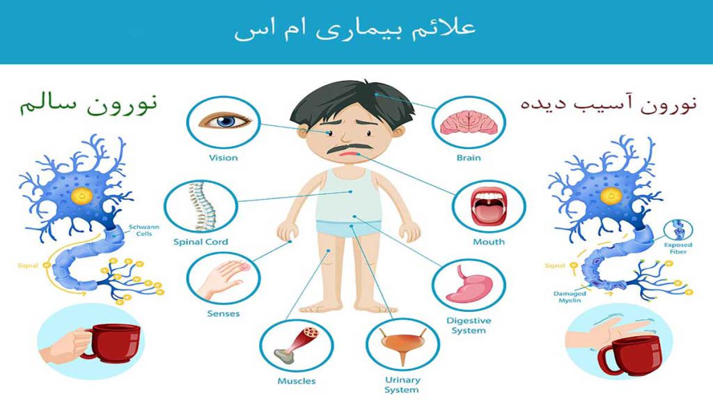 بیماری ام اس و ازدواج بیماری ام اس و ازدواج، طلاق و مهریه