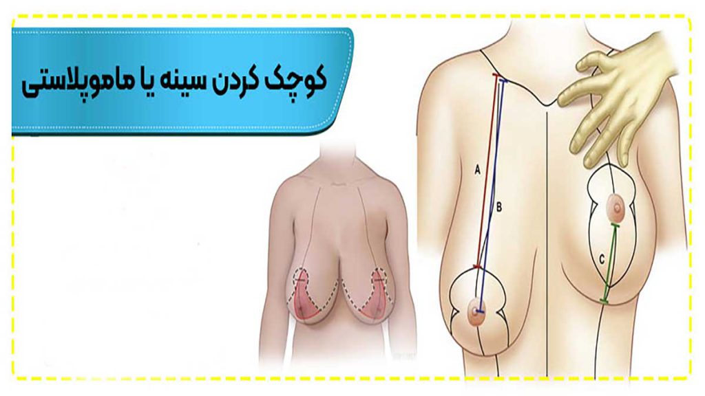 کلینیک ماموپلاستی سینه بهترین مرکز ماموپلاستی سینه