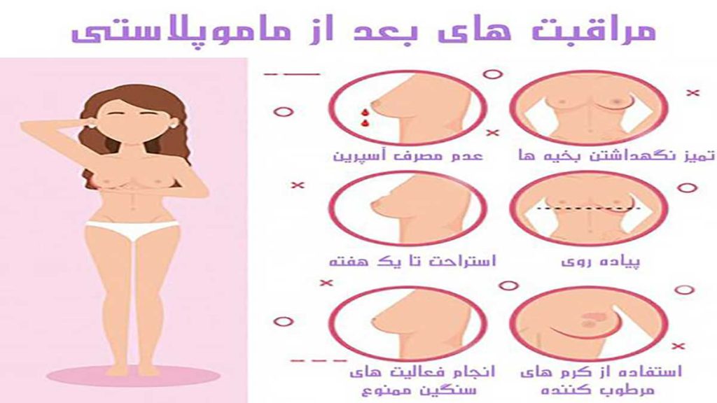 مراقبت های عمل ماموپلاستی بعد از عمل ماموپلاستی چه مراقبت هایی لازم است