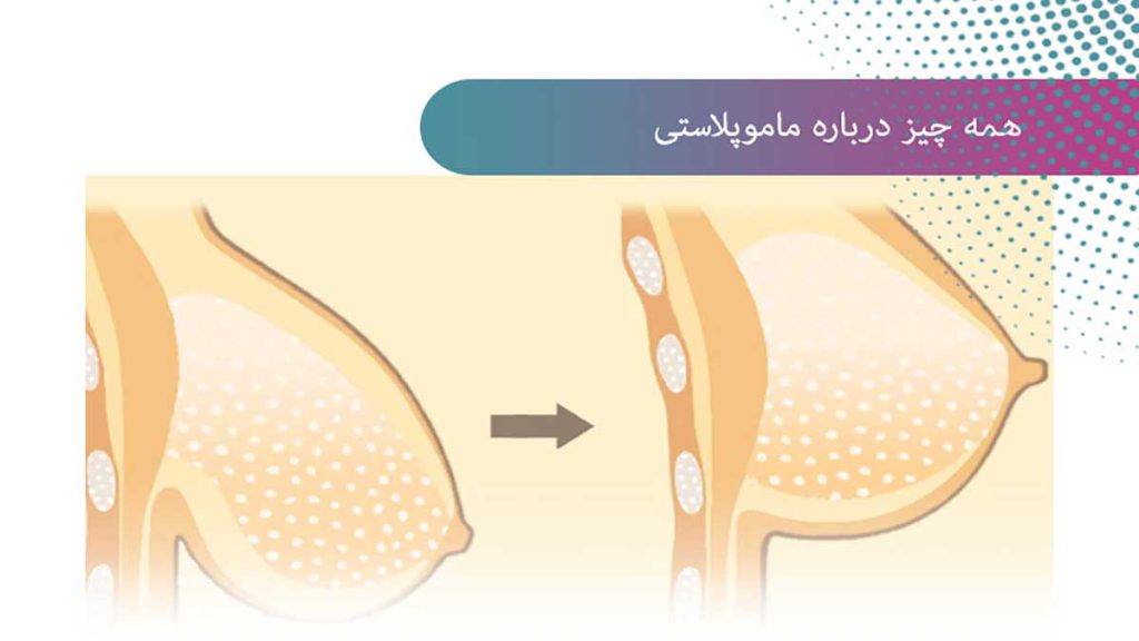 قیمت ماموپلاستی عوامل موثر روی هزینه ماموپلاستی سینه